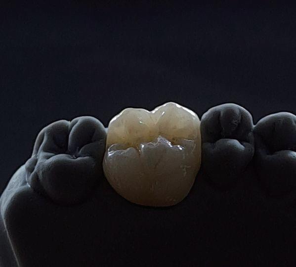 Glass-ceramic crown seated on a model