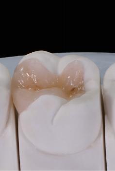 Glass-ceramic inlay