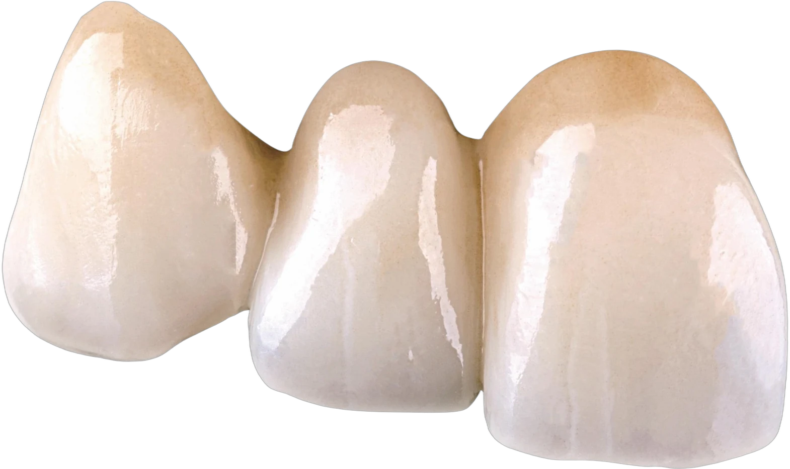 Zirconia anterior bridge