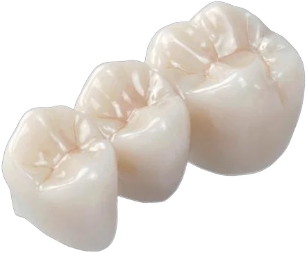 Zirconia posterior bridge